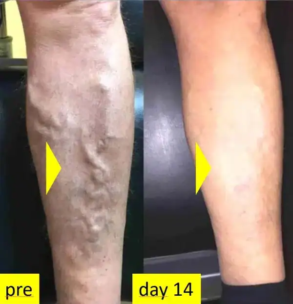 ScleroGlue-testimonial